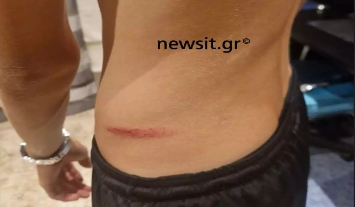 Πάτρα: «Είχε ζαλιστεί και εκείνος συνέχισε να τον χτυπάει», λέει η μητέρα του 14χρονου που δέχτηκε την επίθεση για μια κοπέλα