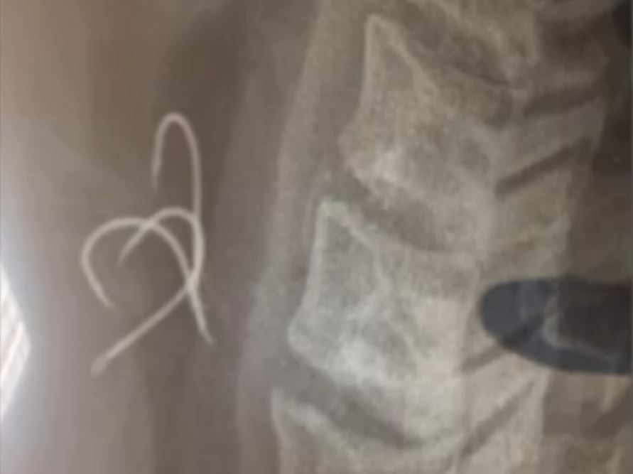 «Έγινα μπλε»: Τι λέει ο 38χρονος που κατάπιε αγκίστρια